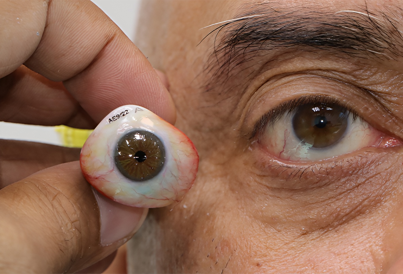Ocular Prosthesis Clinic