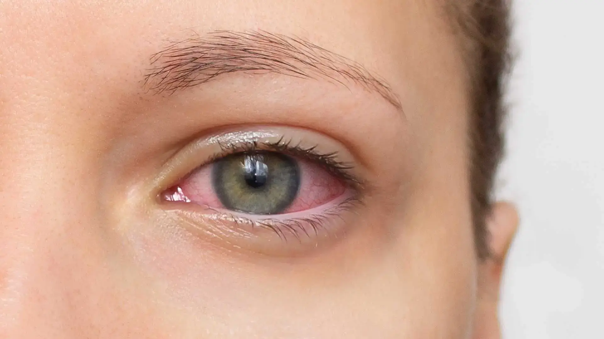 Uveitis Clinic